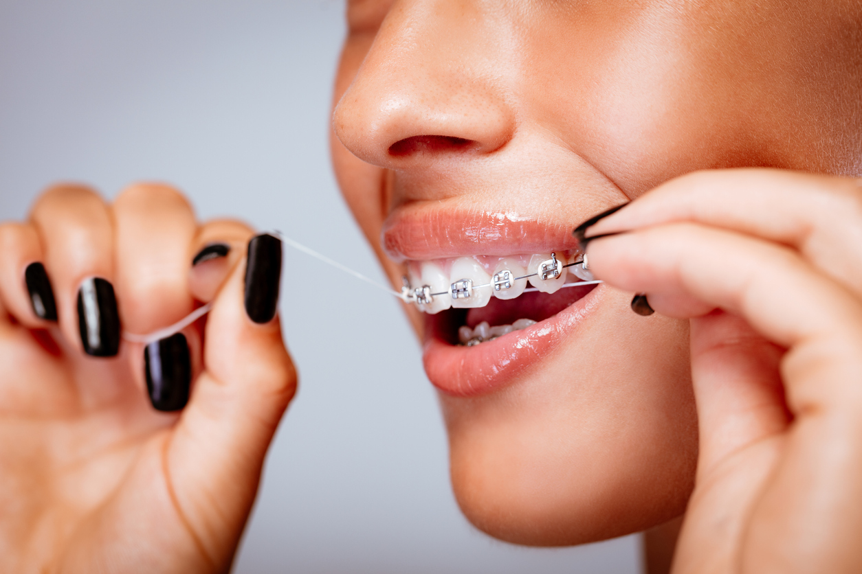 Floss with braces - Oral Care with Braces