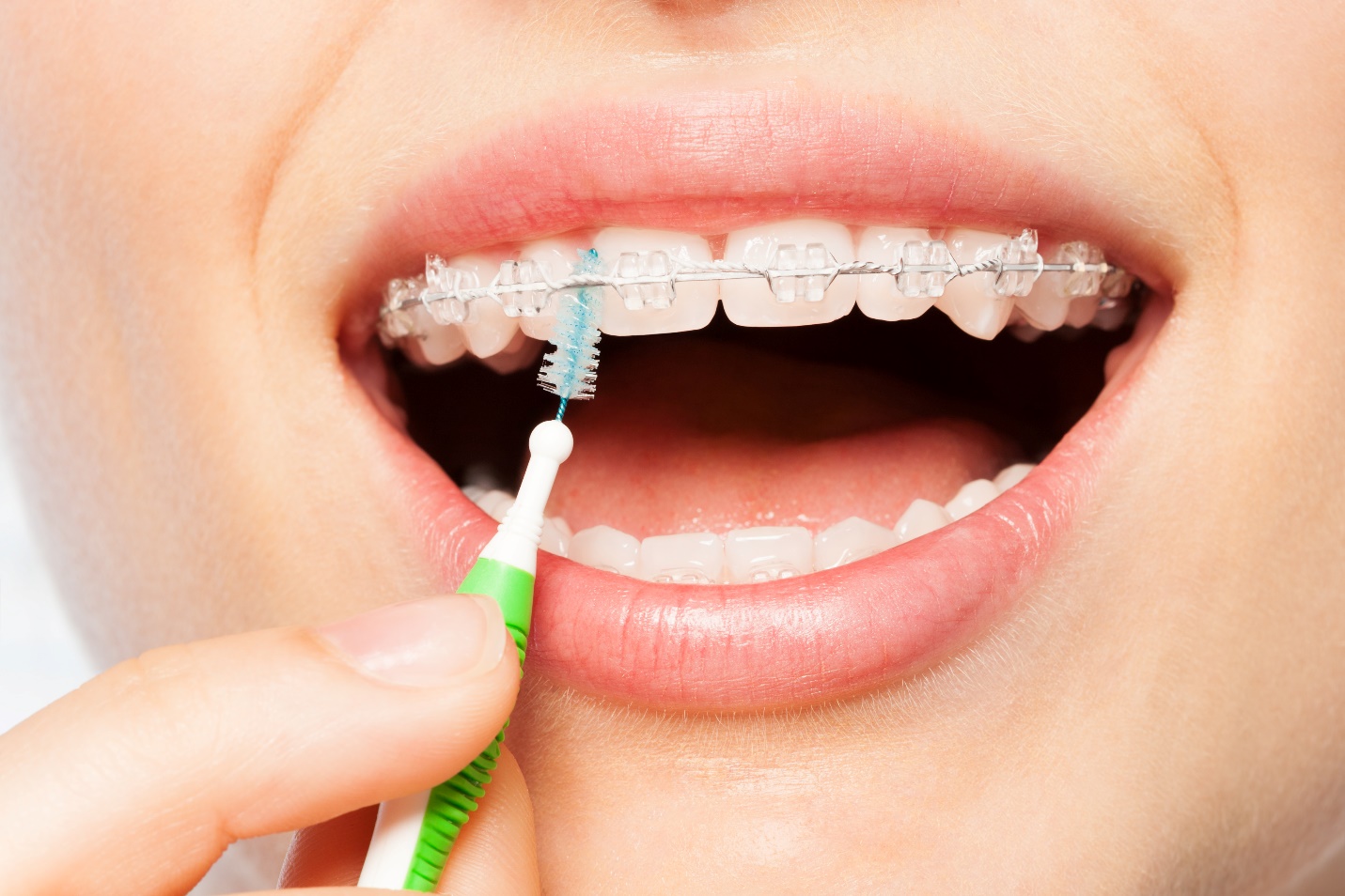 Clean Ceramic braces - Oral Care with Braces