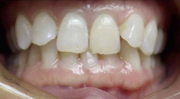 Teeth Overbite - Fix Overbite Teeth