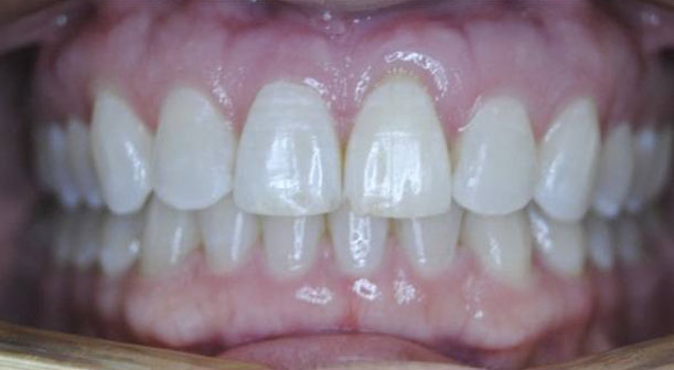Teeth Overbite - Braces Before and After