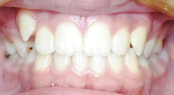 Crowded Teeth - Common Problems with Braces