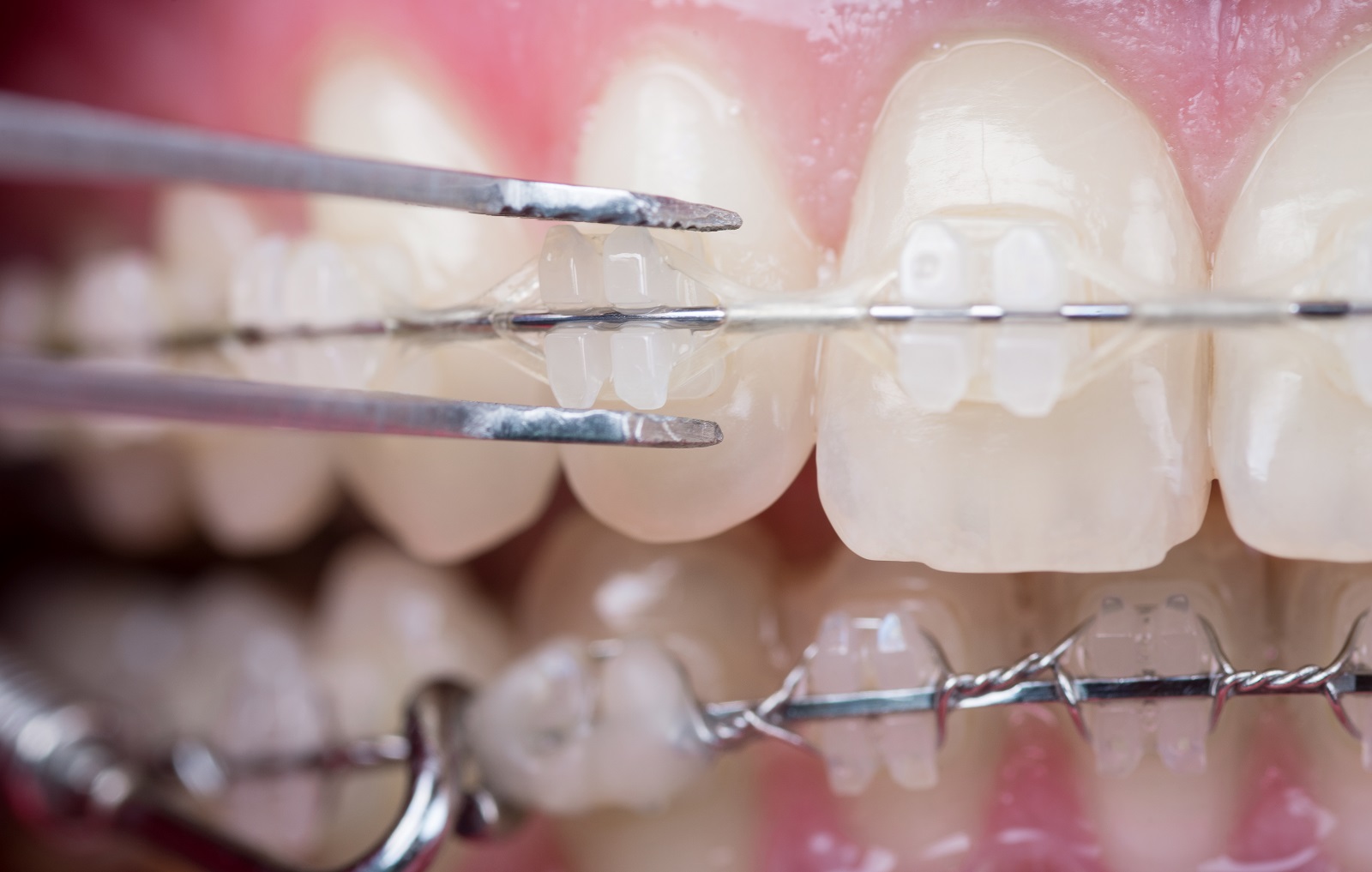 Ceramic Brace Closeup | Dr Murray Orthodontics