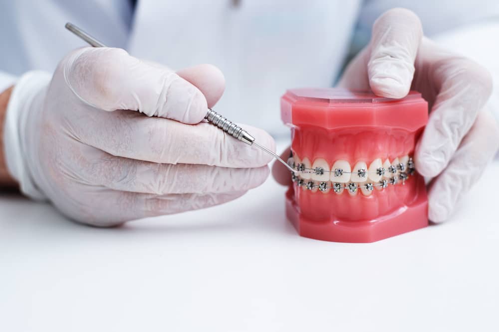 Metal Braces for Teeth Correction