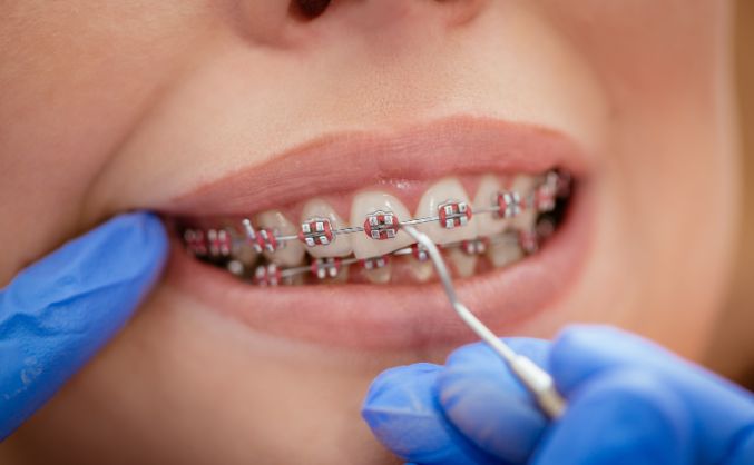 Dr. Murray offers metallic braces and invisible braces