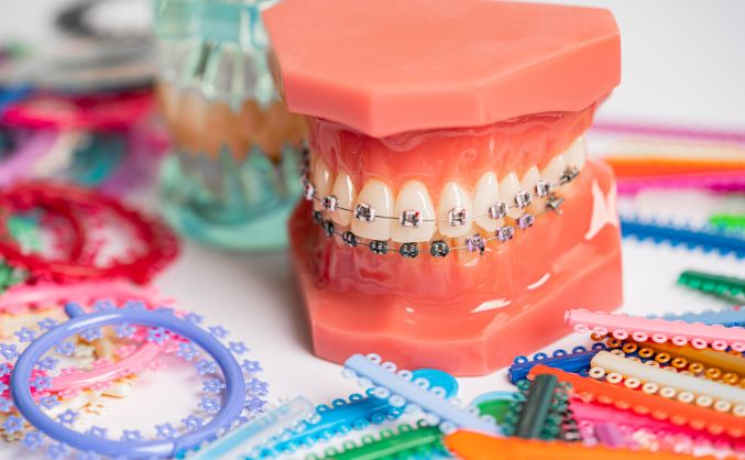 What Do Rubber Bands Do for Braces & Your Smile?