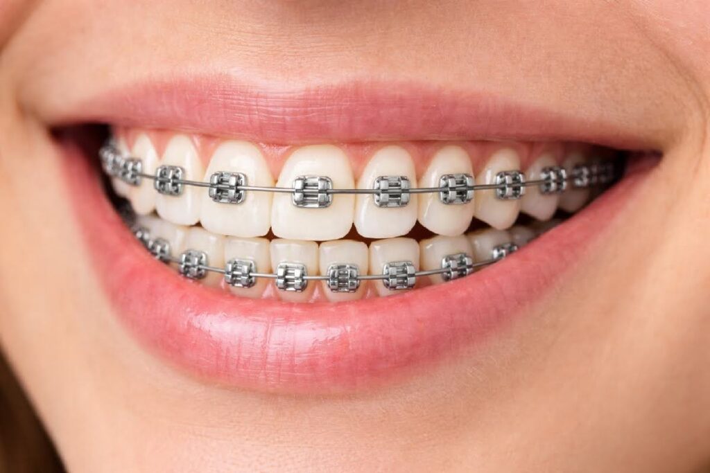 Traditional metal braces aligning outward front teeth
